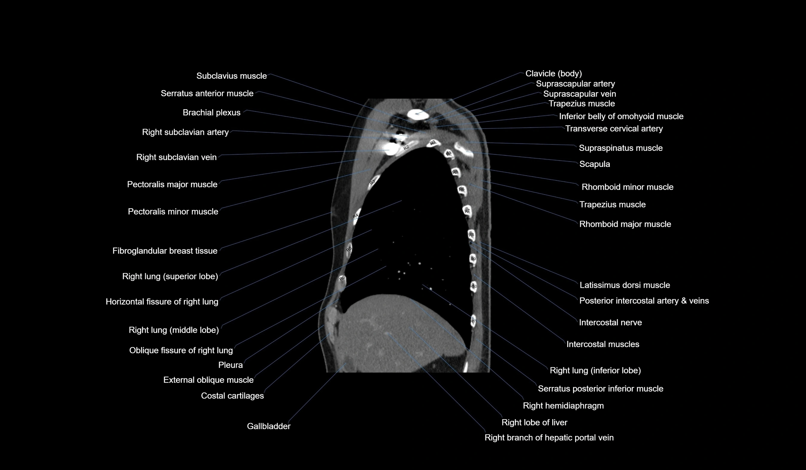 CT chest (thorax) soft tissue window labelled sagittal cross sectional anatomy radiology image-00035.webp